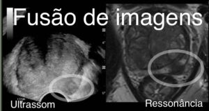 Investigando o câncer de próstata. Saiba mais sobre o câncer mais frequente nos homens!