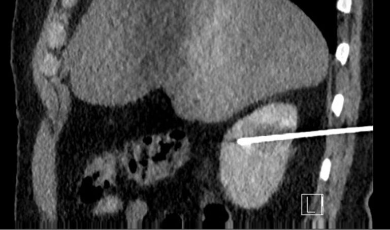 Nódulo renal: o que é e o que fazer com este achado de imagem!