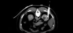 Nódulo renal: o que é e o que fazer com este achado de imagem!