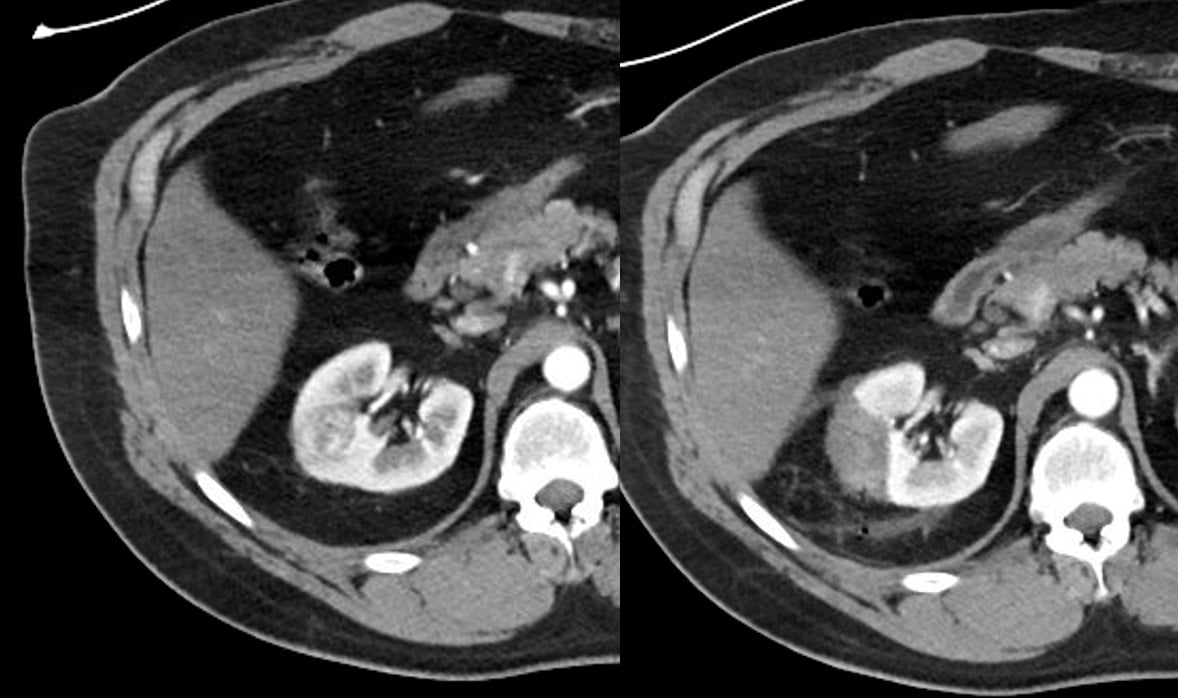 Nódulo renal: o que é e o que fazer com este achado de imagem!