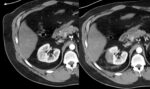 Nódulo renal: o que é e o que fazer com este achado de imagem!