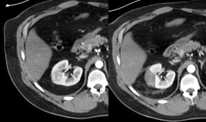 Nódulo renal: o que é e o que fazer com este achado de imagem!