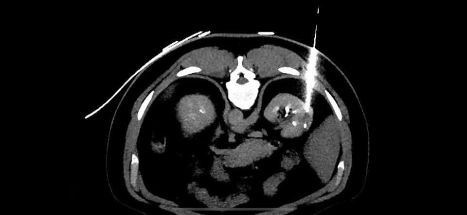 Nódulo renal: o que é e o que fazer com este achado de imagem!