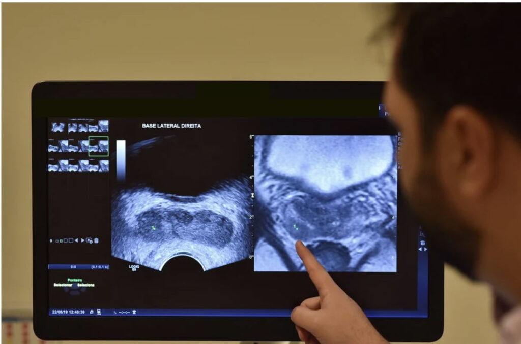 O que é a biópsia de próstata com fusão de imagens em pacientes com Ressonância PI-RADS 4 e PI-RADS 5?