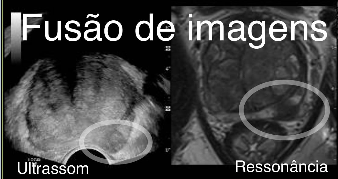 O que é a biópsia de próstata com fusão de imagens em pacientes com Ressonância PI-RADS 4 e PI-RADS 5?